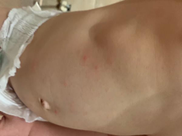 Vyrážka. Na co dalšího se zaměřit?