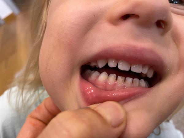 Jsou žluté skvrny na zubech příčinou kazů?