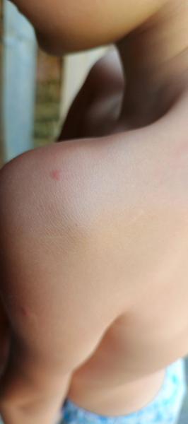 Pupínky na zádech u dítěte: Co to může znamenat?