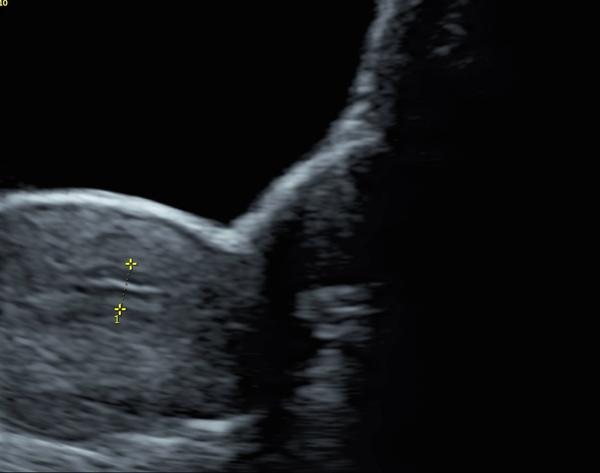 Co znamená čárka na ultrazvuku? Prosím o radu