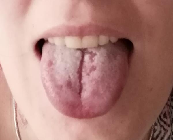 Jazyk. Mohlo to vzniknout z horkého jídla?