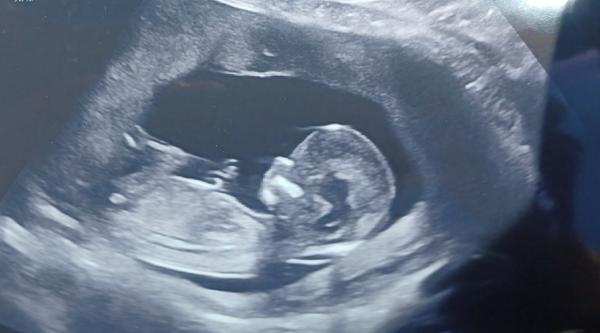Ultrazvuk - holčička či chlapeček ?