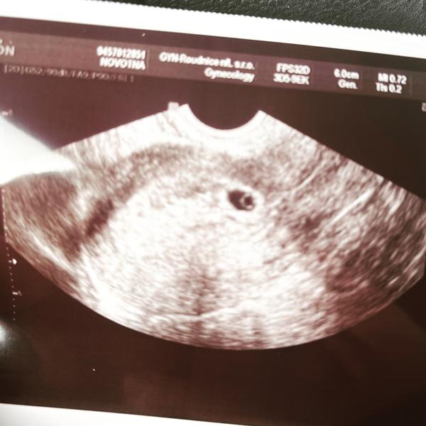 Máte zkušenost s polohou plodu blízko čípku?