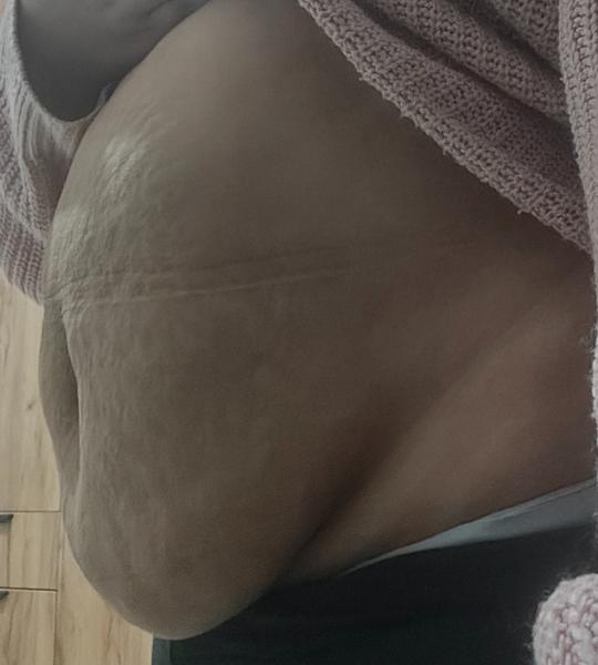 Jak zpevnit vytahané břicho po porodu?