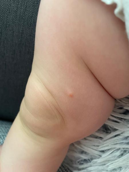 Co znamenají suché tečky po těle dítěte?