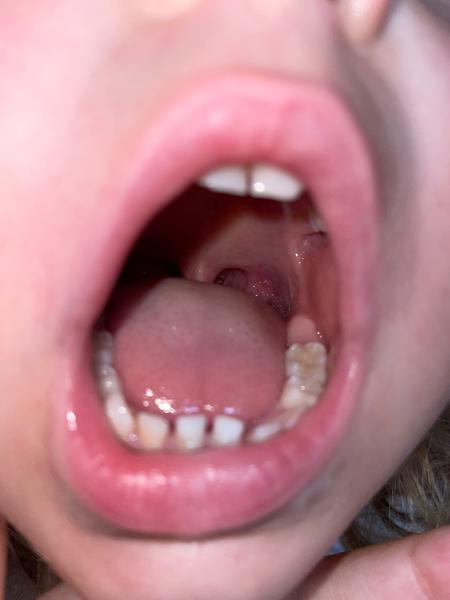 Mohou čtyřletému dítěti růst šestky?