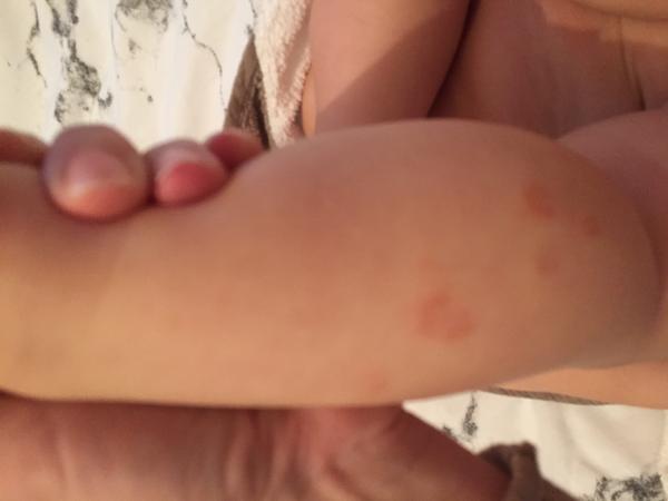 Ekzém, promašťovat nebo vysušovat?