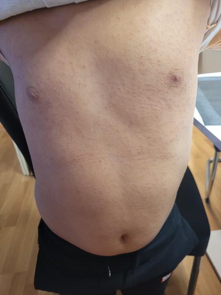 Svědivé pupínky. Co by to mohlo být?