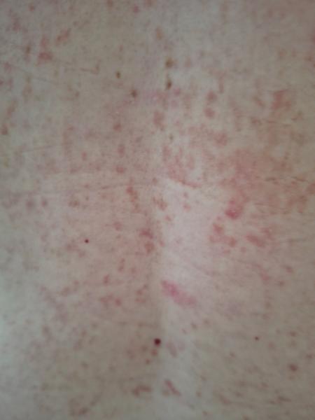 Svědící vyrážka. Co by to mohlo být?