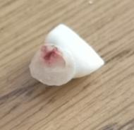 První návštěva zubaře po vypadnutí mléčného zubu?