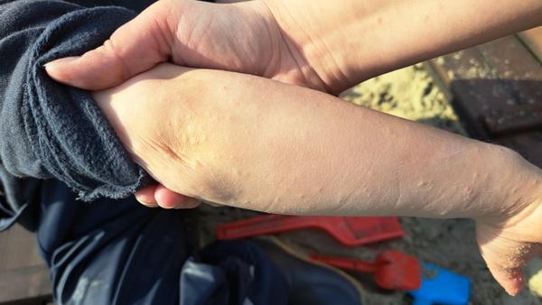 Možné příčiny svědivé vyrážky u dvouletého dítěte