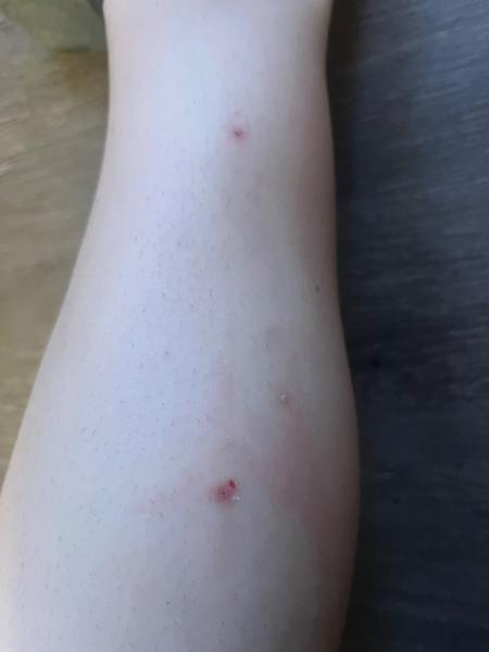 Jak řešit svědění a vyrážku na těle?