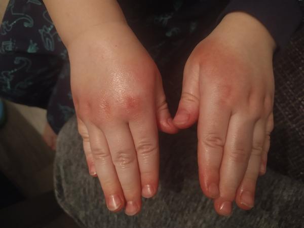 Může být suchá pokožka a svědění příznakem ekzému?