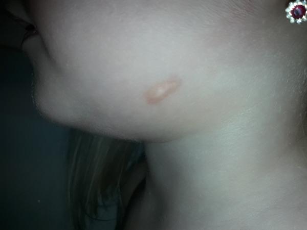 Flíček na kůži po zlatém stafylokokovi