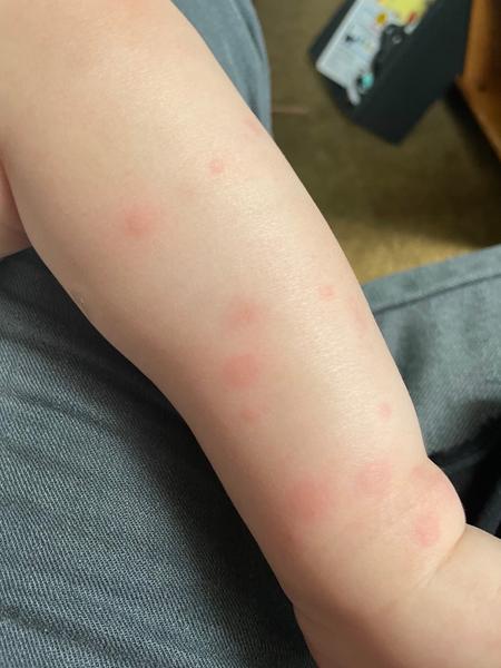 Příčiny mizejících fleků u dětí. Co funguje na vyrážky?