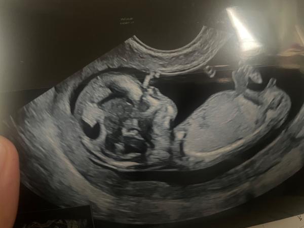 Setkaly jste se při screeningu s vadou obličeje?