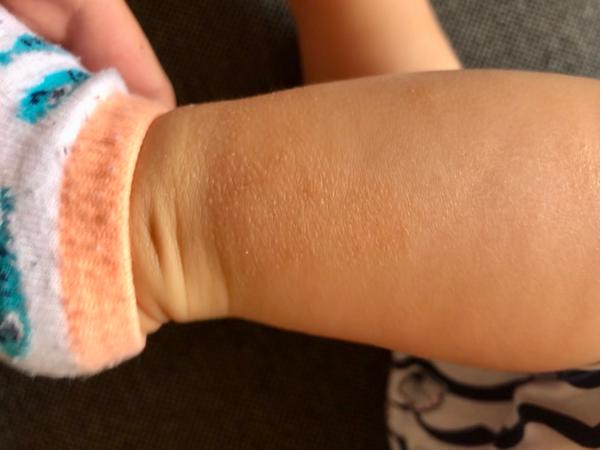 Atopický ekzém. Mohl by to být?