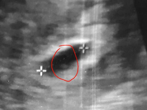 Sono v 5+6.tt. Plod nebo ne?