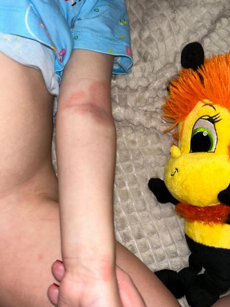 Locoid na atopický ekzém. Je to správné řešení?