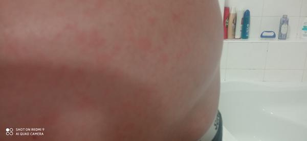 Vyrážka na břiše z ničeho nic🤷😳🤔. Poradíte, prosím?