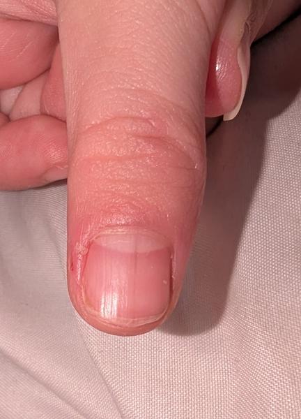 Rýha pod nehtem. Mám se obávat?