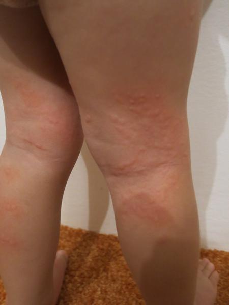 Výsev "puchýřků" u dvouletého dítěte, prosím o radu