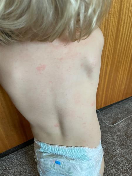 Vyrazily vašemu dítěti vyrážky po horečce? Co to může být?