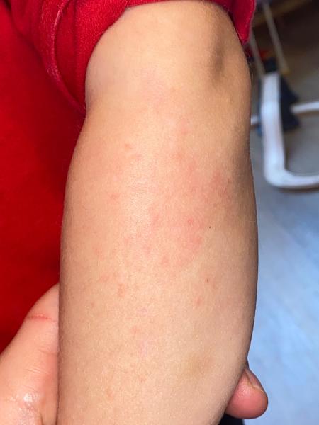 Je vyrážka po léčbě svrabem známkou návratu infekce?