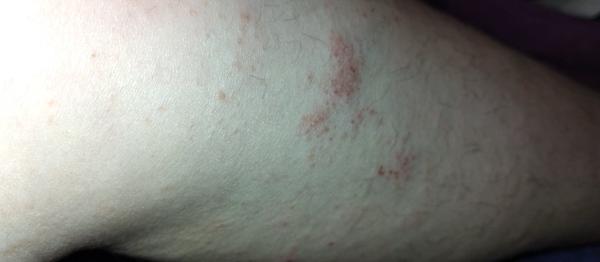 Pupínky po těle: Jak poznat svrab?