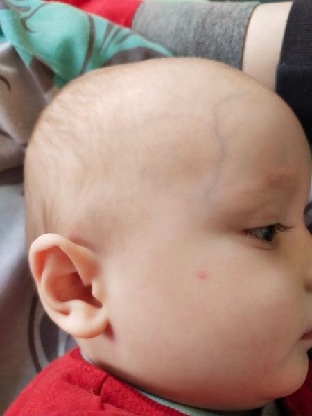 Neštovice u 15měsíčního dítěte v lázních: Příznaky?