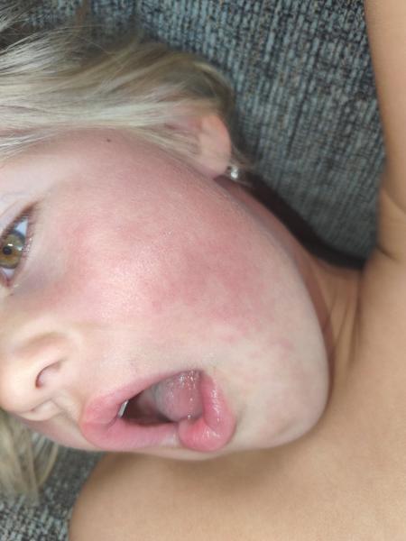 Sedmá nemoc u dětí: Jak ji rozpoznat?