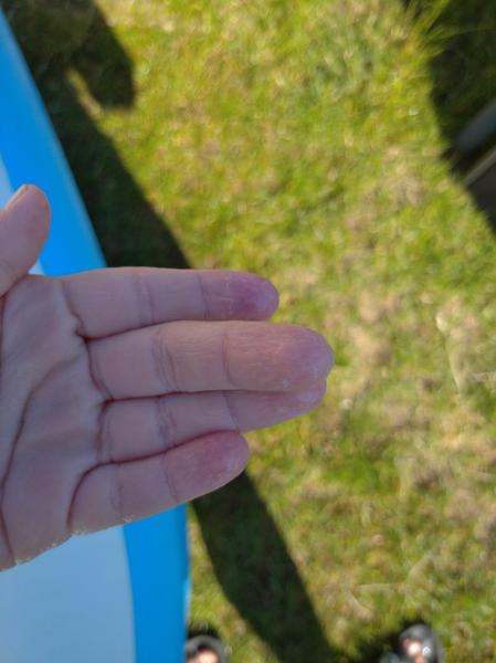 Červené flíčky a slouplé konečky prstů - doplnění fotografií loupající se kůže na bruskách prstů