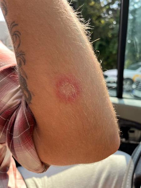 Kožní problém nezastavitelný a nereagující na kortikoidy. Co dělat?