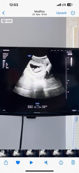 Pohlaví dítěte. Lze určit?