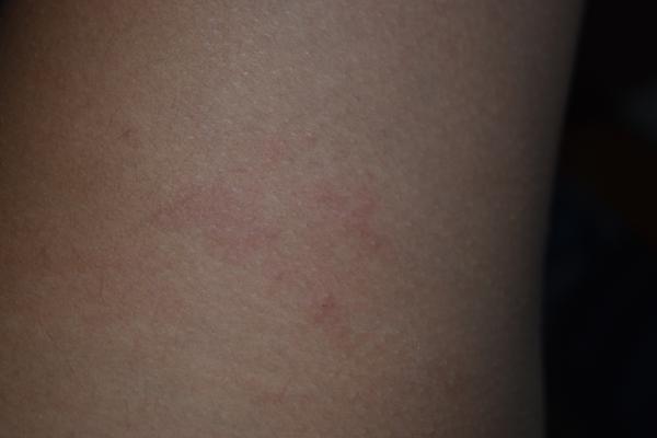 Co způsobuje svědění a vyrážku na kloubech?