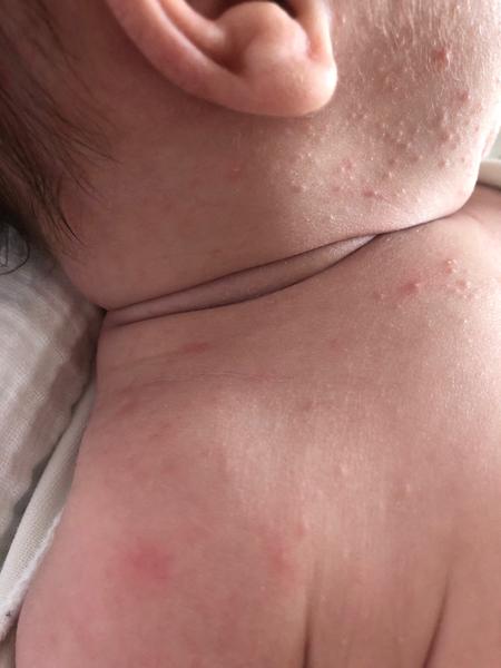 Vyrážka v obličeji a na rukách. Co byste poradila?