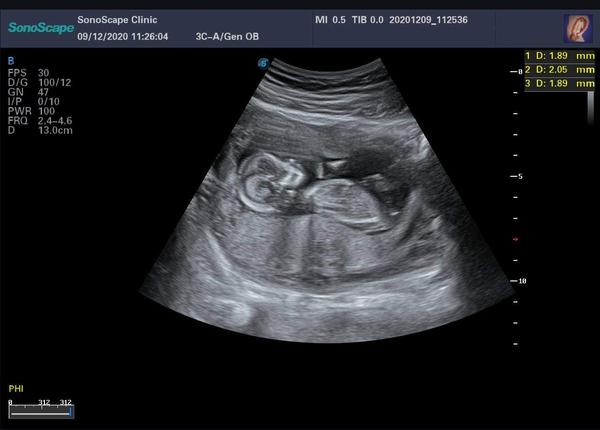 Velikost miminka ve 12. týdnu. Jak velké bylo to vaše?