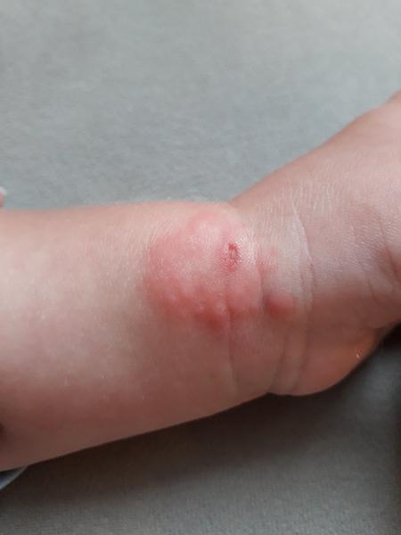 Bolák na ruce u 2letého dítěte. Co by to mohlo být? Čím mazat?