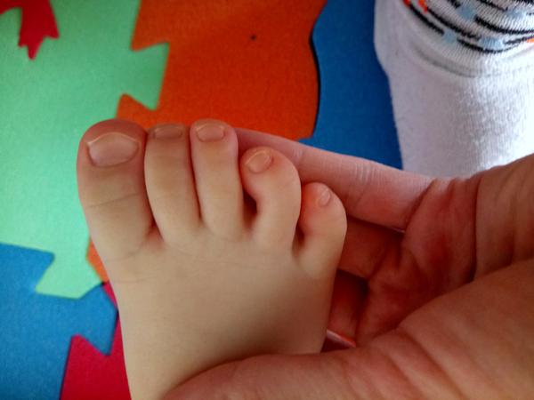 Deformace prstu. Jak se řeší?