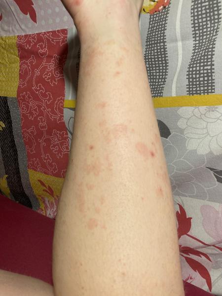 Vyrážka a skvrny na nohou. Co by to mohlo být?