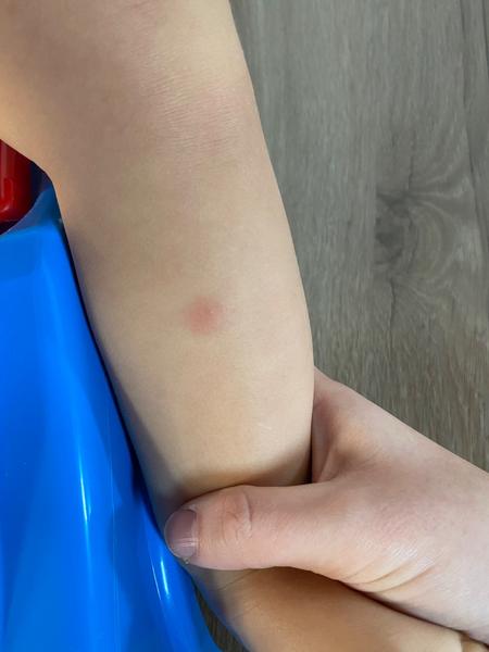 Co způsobuje bolestivé červené pupínky po prodělaném covidu?