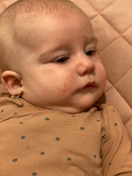 Je to alergie nebo ekzém?