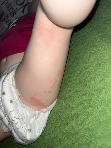 Vyrážka u dítěte. Jak řešit zhoršení po masti?