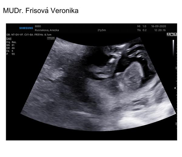 Určení pohlaví miminka, MUDr. Frisova, profema. Co myslíte vy?