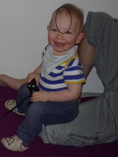 Syn má hrb na hlavě, co to může být?