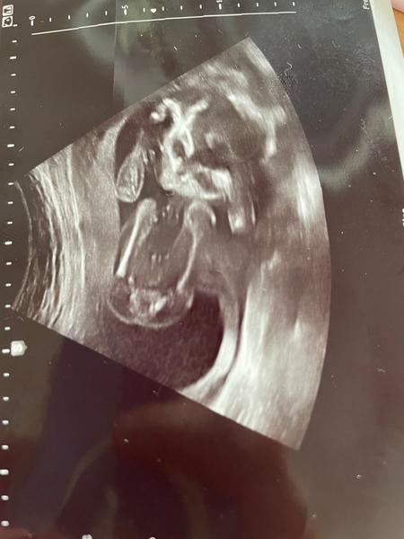 Chlapec nebo děvče?