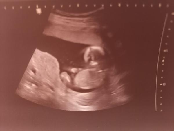 Ultrazvuk: Holka nebo kluk? Co si myslíte?