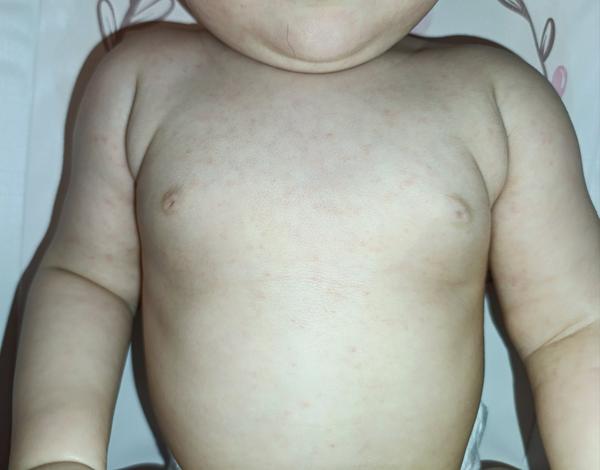 Vyrážka a nespaní u dcery. Jsou to zoubky?