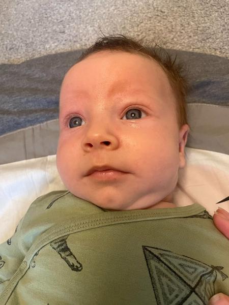 Opar u novorozence. Je nutná návštěva lékaře?