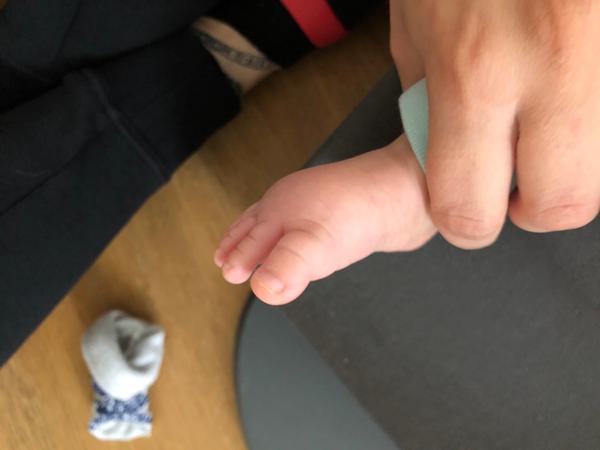 Zatnuté prstíky. Je to normální?